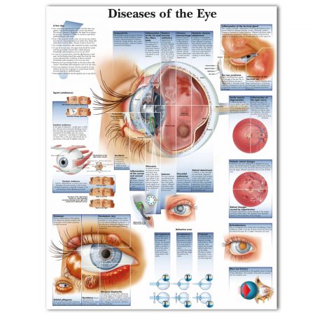Diseases Of The Eye Chart